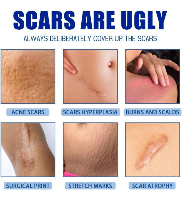 Plastic Scar Removal Cream (White-Blue) - Image 5
